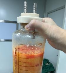 磁县水动力吸脂手术要做多久？